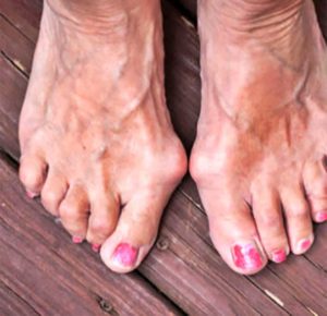 bunions, foot surgery