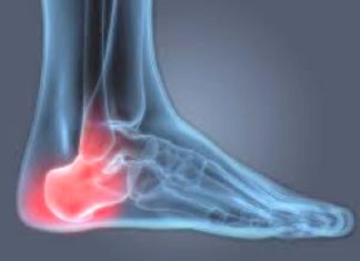 3 Tips to Reduce or Eliminate Heel Pain Foot Solutions, Heel