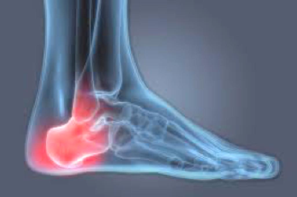 heel bone pain