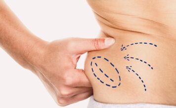 Options for Medical Fat Reduction