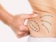 Options for Medical Fat Reduction