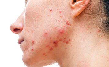 Medical Options for Acne