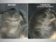 Regenerative Medicine & PRP (Platelet Rich Plasma)