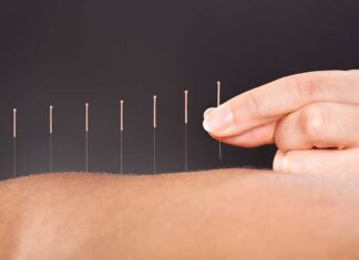 Acupuncture for All acupuncture