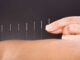 Acupuncture for All acupuncture