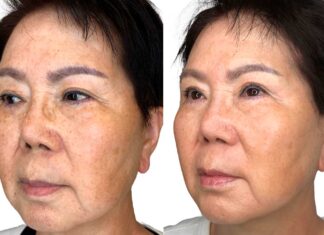 What is Non-Invasive Skin Tightening?