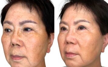 What is Non-Invasive Skin Tightening?
