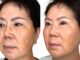What is Non-Invasive Skin Tightening?