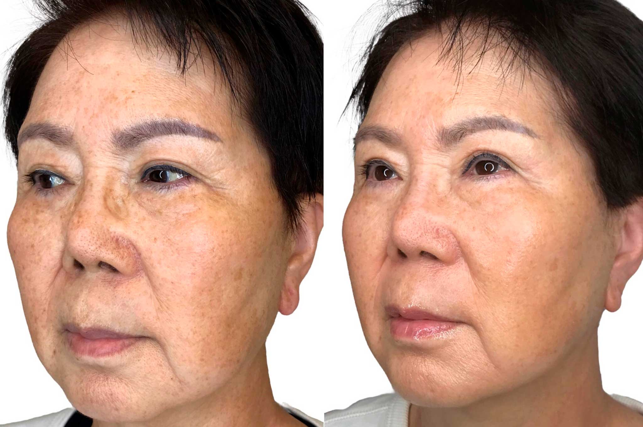What is Non-Invasive Skin Tightening? - Tigard Life