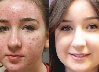 Medical Options for Acne