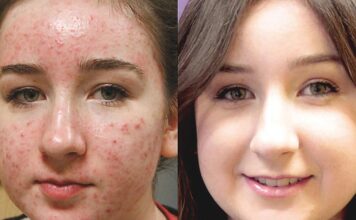 Medical Options for Acne
