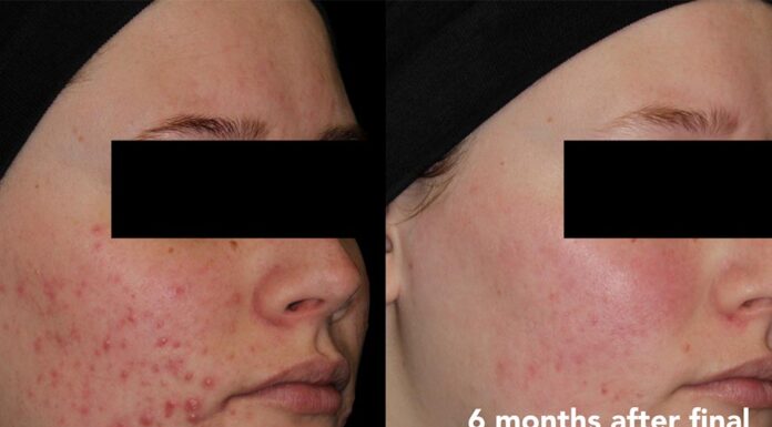 My child has bad acne! What’s a parent to do?