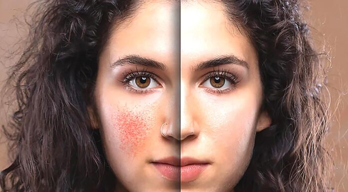 The Power of PRF and Benev Exosomes: Transforming Skin & Hair Health