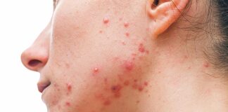 Acne: A Comprehensive Approach to Treatment