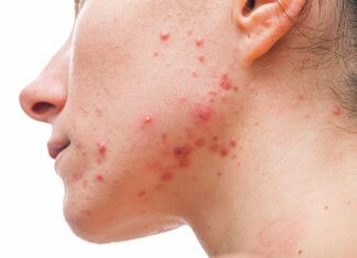 Acne: A Comprehensive Approach to Treatment
