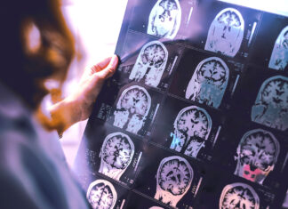 Veterans needed for Alzheimer’s Study