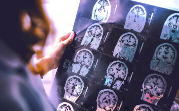 Veterans needed for Alzheimer’s Study